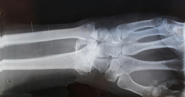 Röntgenaufnahme von Handgelenk